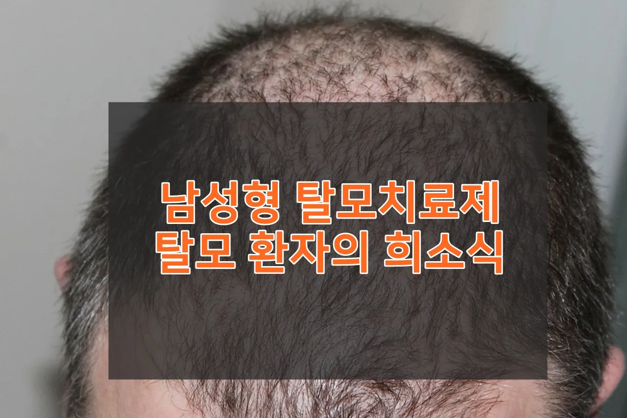 탈모치료 메디톡신-탈모치료제 소식
